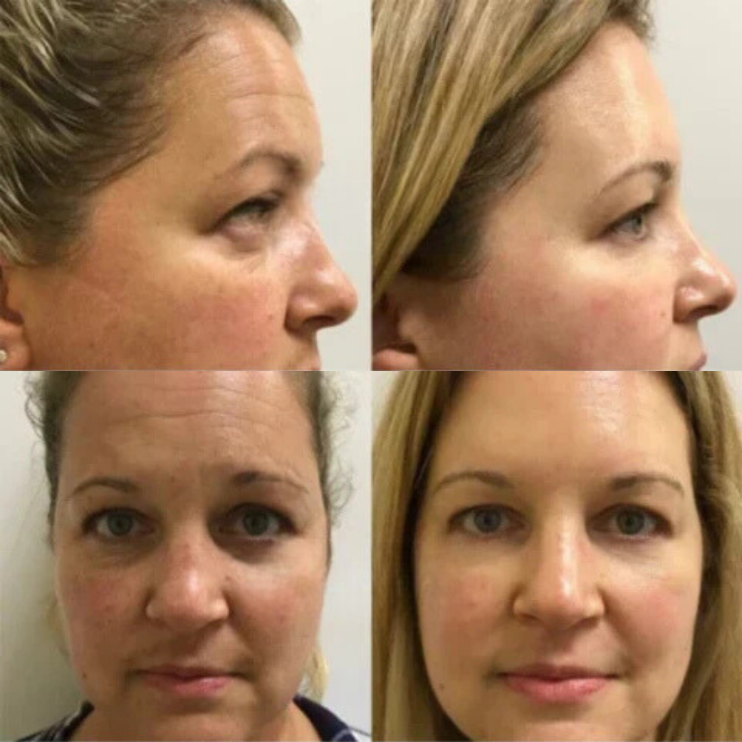 BotoxLift™ | Wrinkle Treatment Serum
