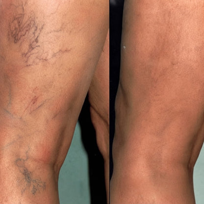 VenoEase™ | Reduce the appearance of varicose veins by up to 98% in 5 days and show your legs with pride again