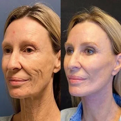 BotoxLift™ | Wrinkle Treatment Serum