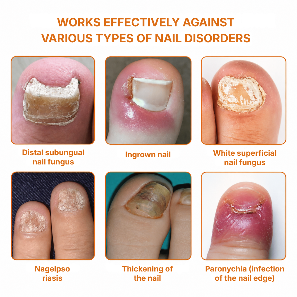 MycoMira™ Fungal Nail Treatment