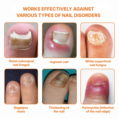MycoMira™ Fungal Nail Treatment