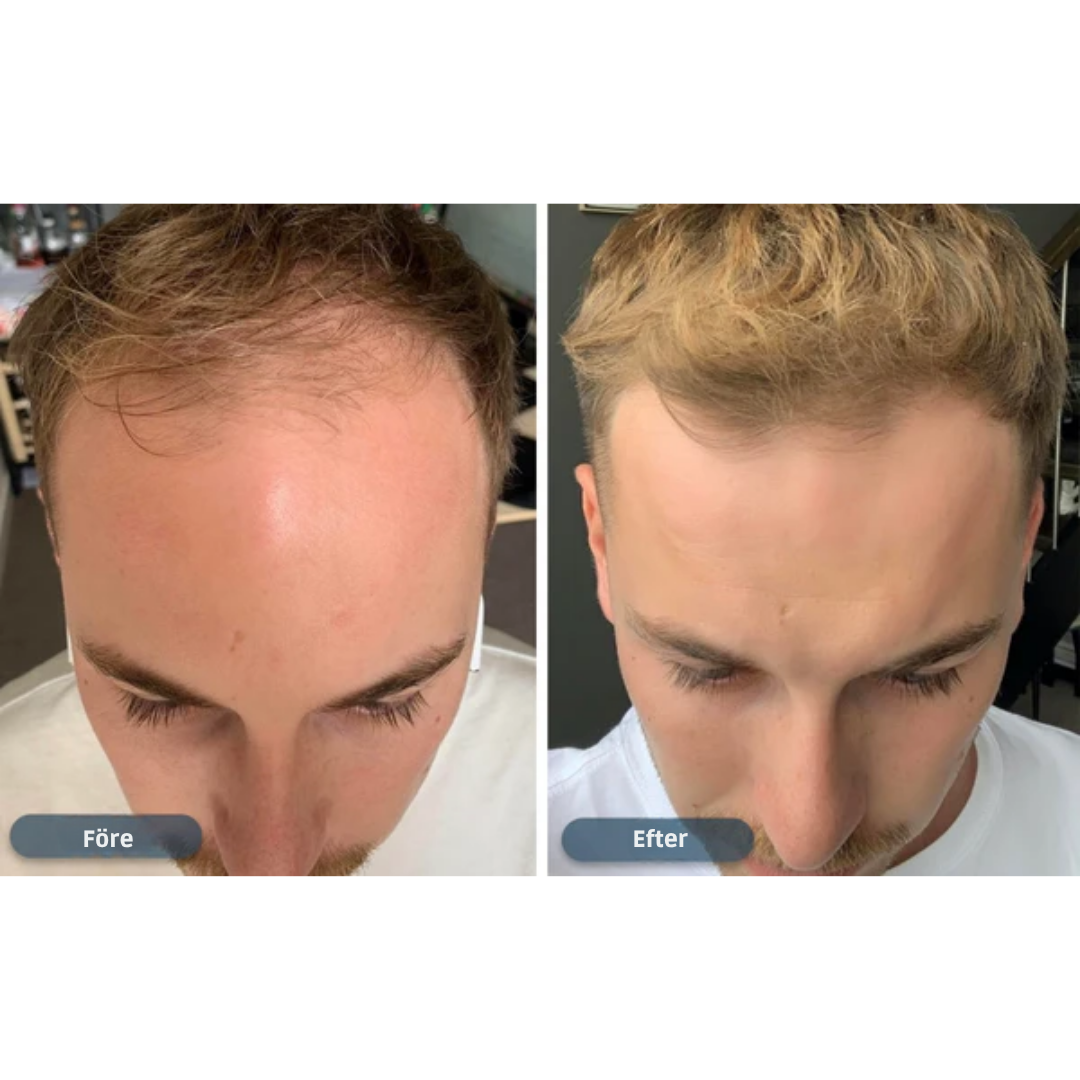 HårVäxt™ – Minoxidil lotion 5 % (1 månads förråd)