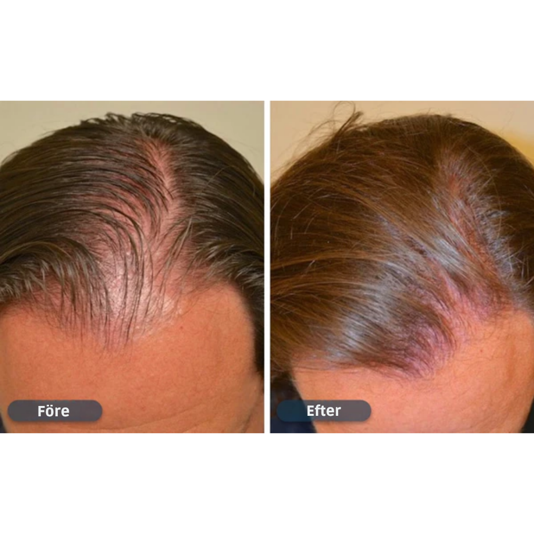 HårVäxt™ – Minoxidil lotion 5 % (1 månads förråd)