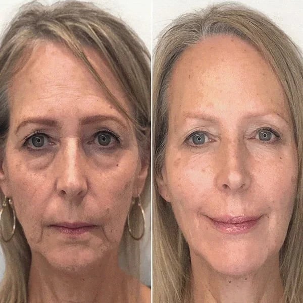 BotoxLift™ | Wrinkle Treatment Serum